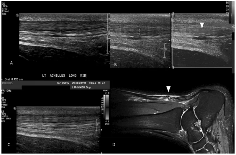 Achilles tendon ultrasound